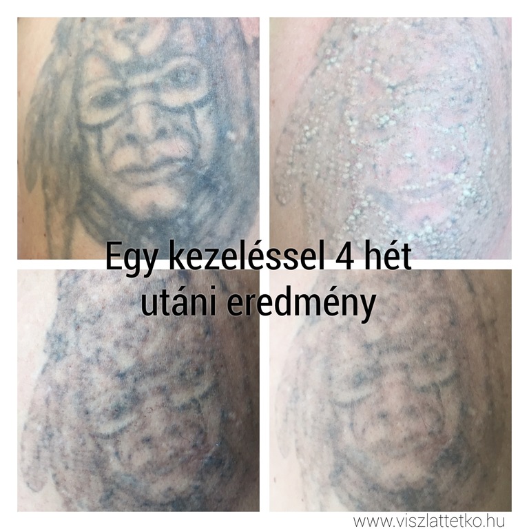 Tetoválás lézerrel történő eltávolítása, az első kezelés után négy hetes eredmény